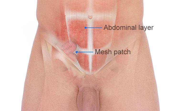 What is a femoral hernia surgery?