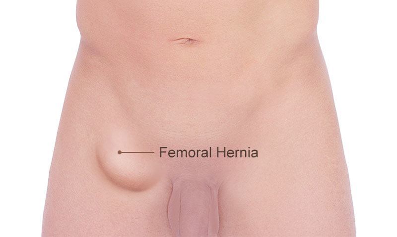 Femoral HerniaTreatment London