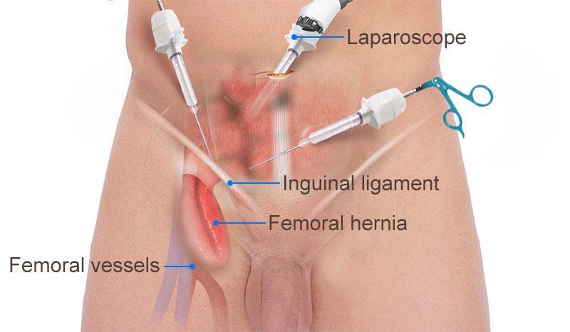 Femoral Hernia Treatment London